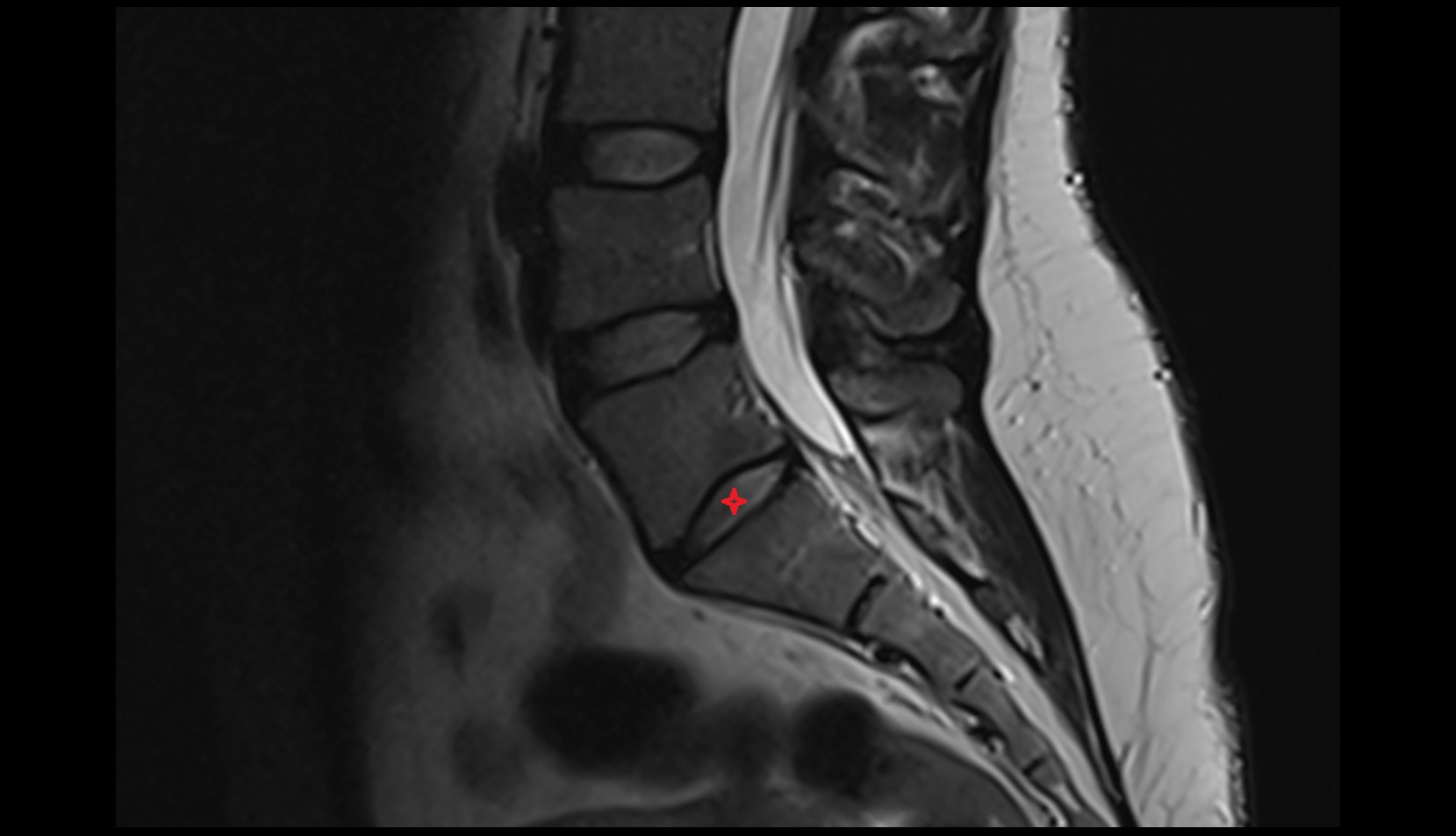 L5–S1 Intervertebral Disc mri sagittal image