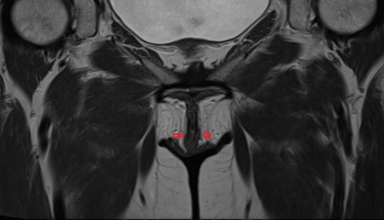 Labia Minora  MRI axial anatomy  image-img-00000-00000_00001