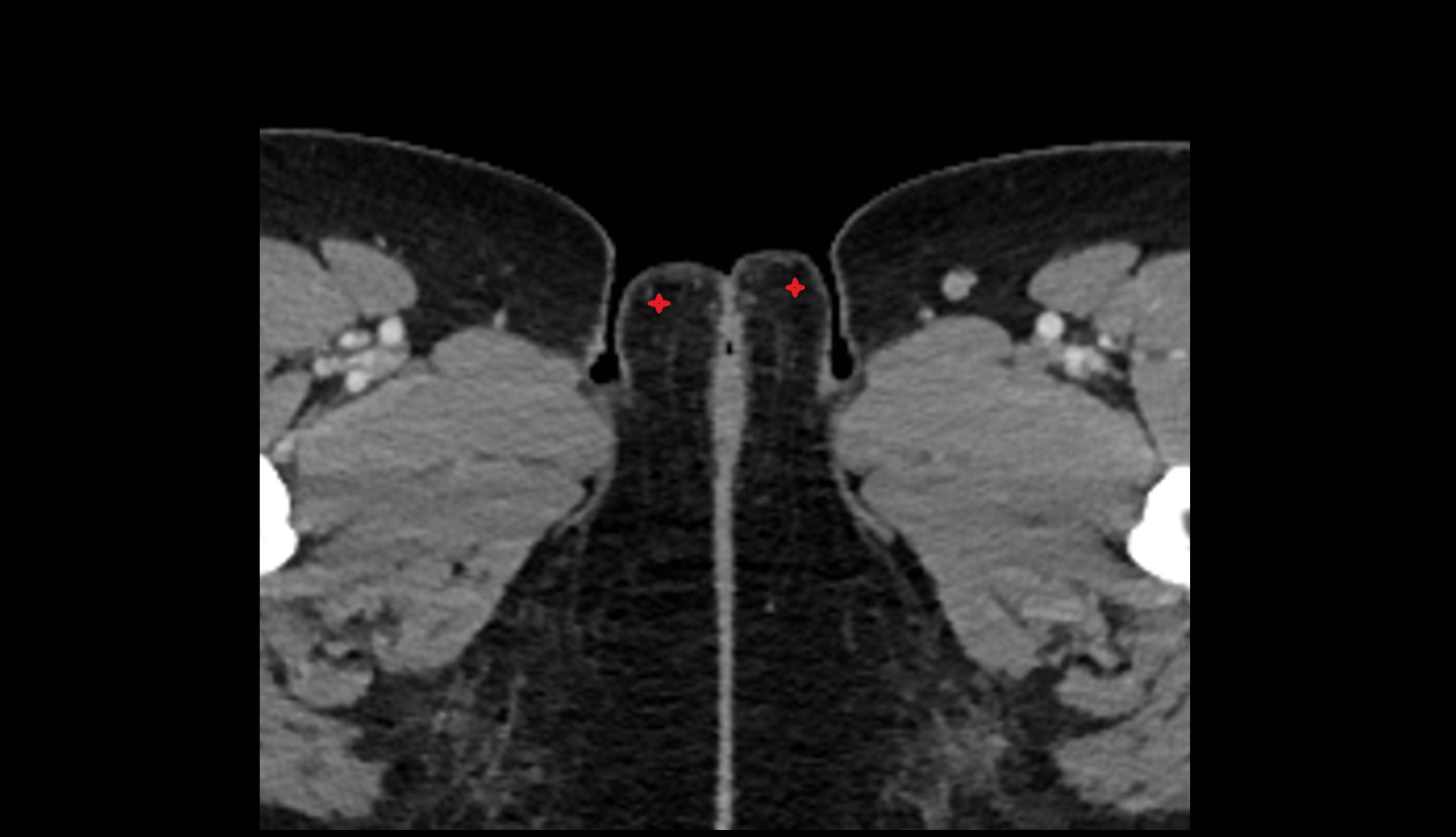 Labia majora CT axial image 1