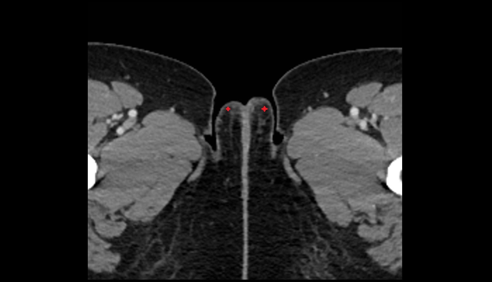 Labia majora CT axial image 2