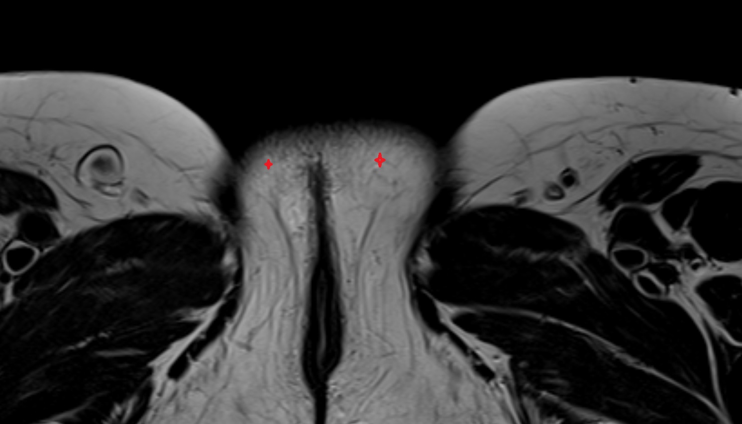 Labia majora  MRI axial anatomy  image-img-00000-00000