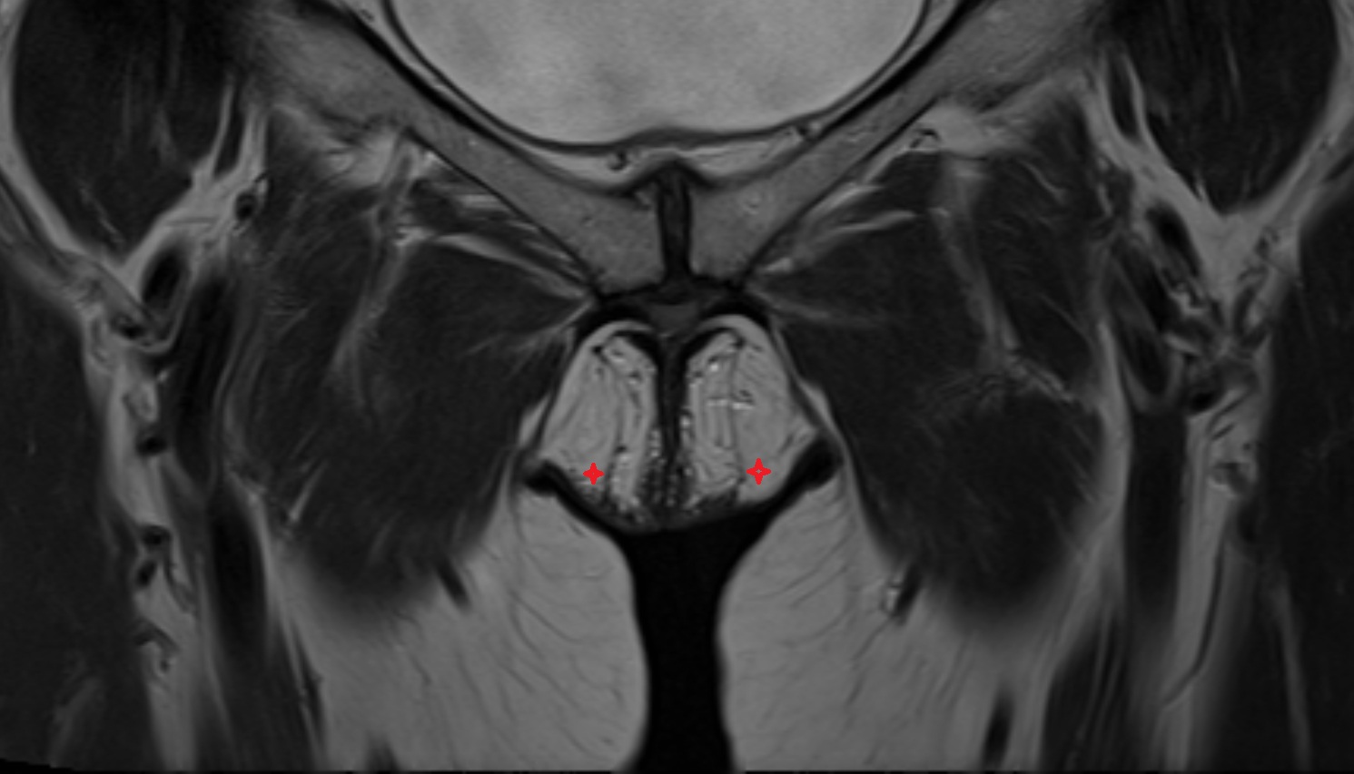 Labia majora  MRI coronal anatomy  image-img-00000-00000