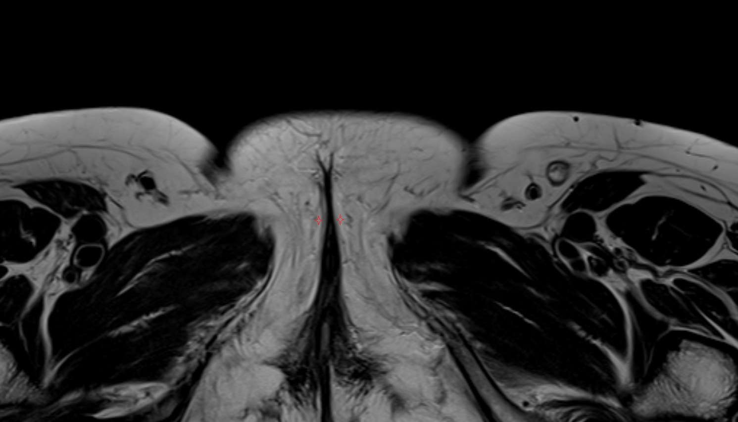 Labia minora  MRI axial anatomy  image-img-00000-00000