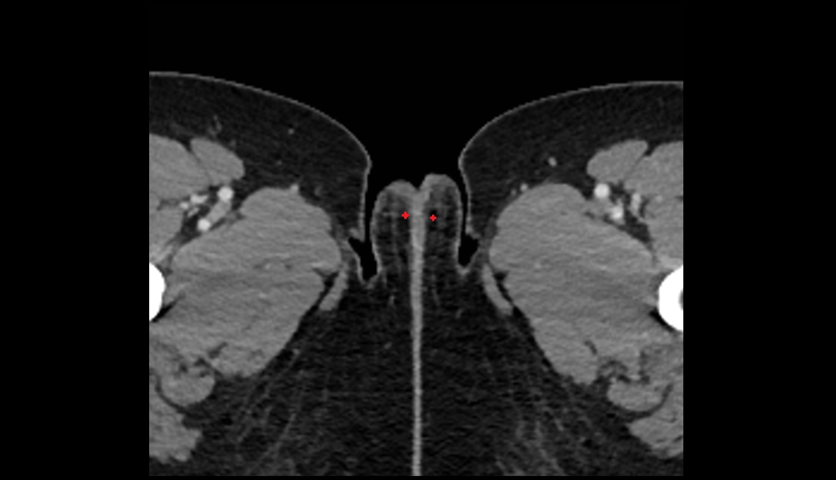 Labia minora ct axial image
