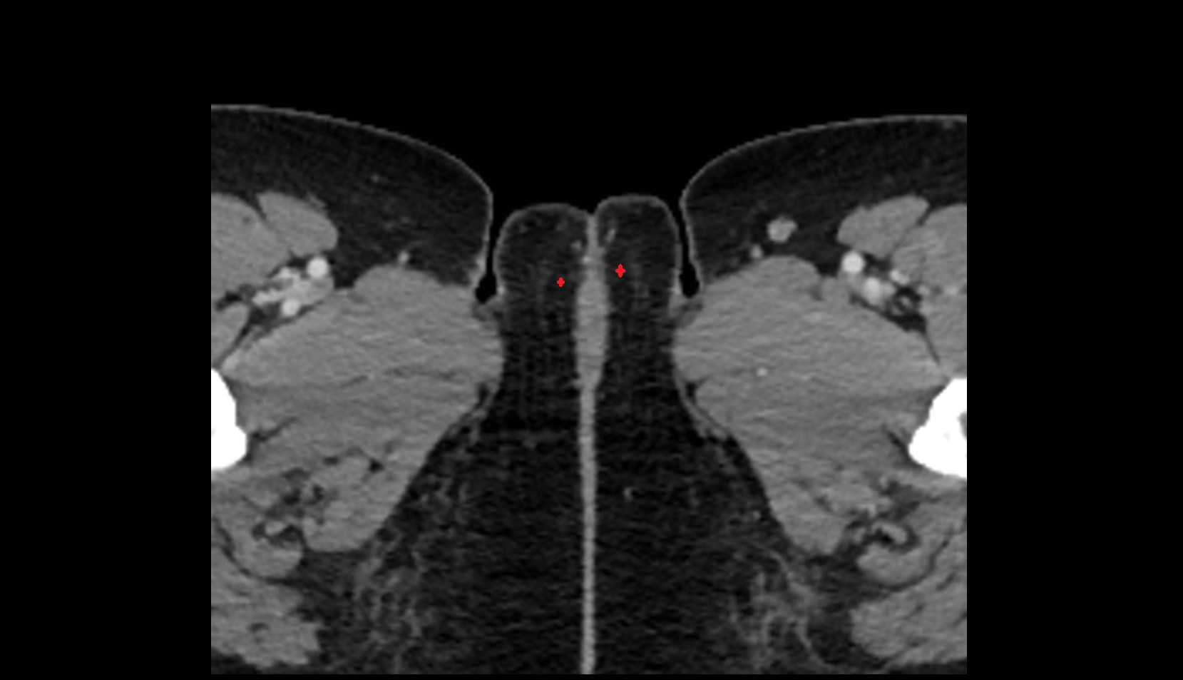 Labia minora ct axial image 1