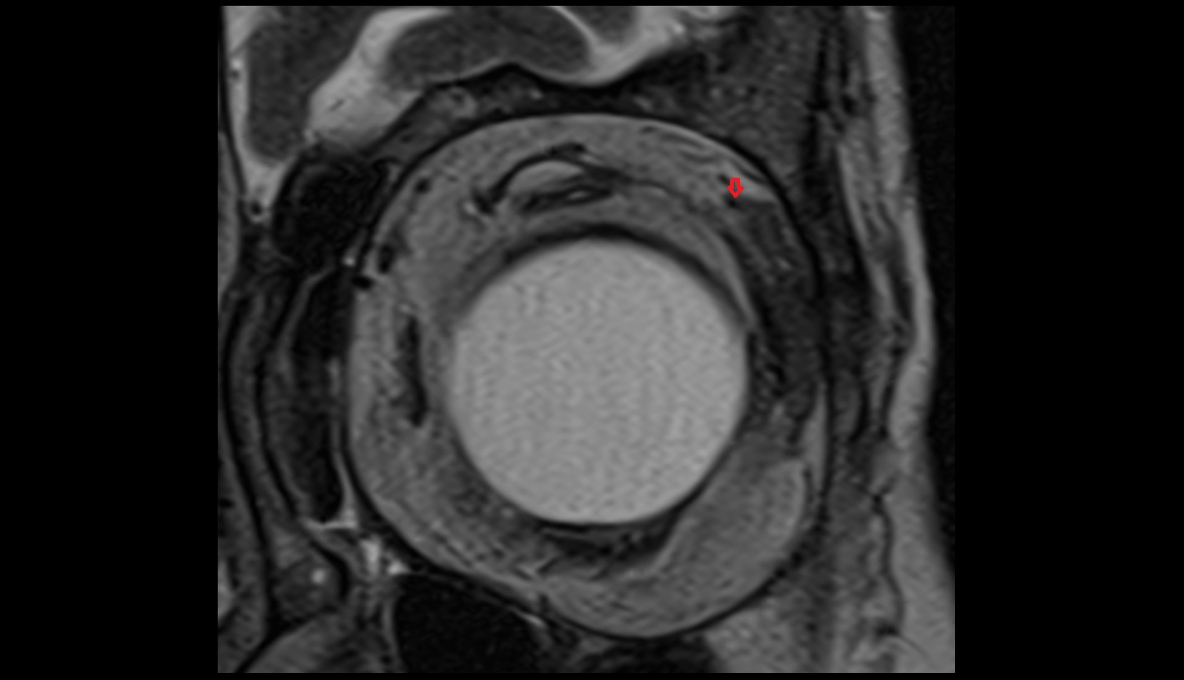 Lacrimal artery mri image