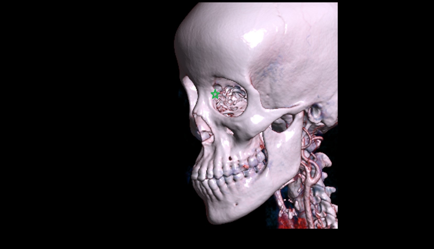 Lacrimal bone 3d