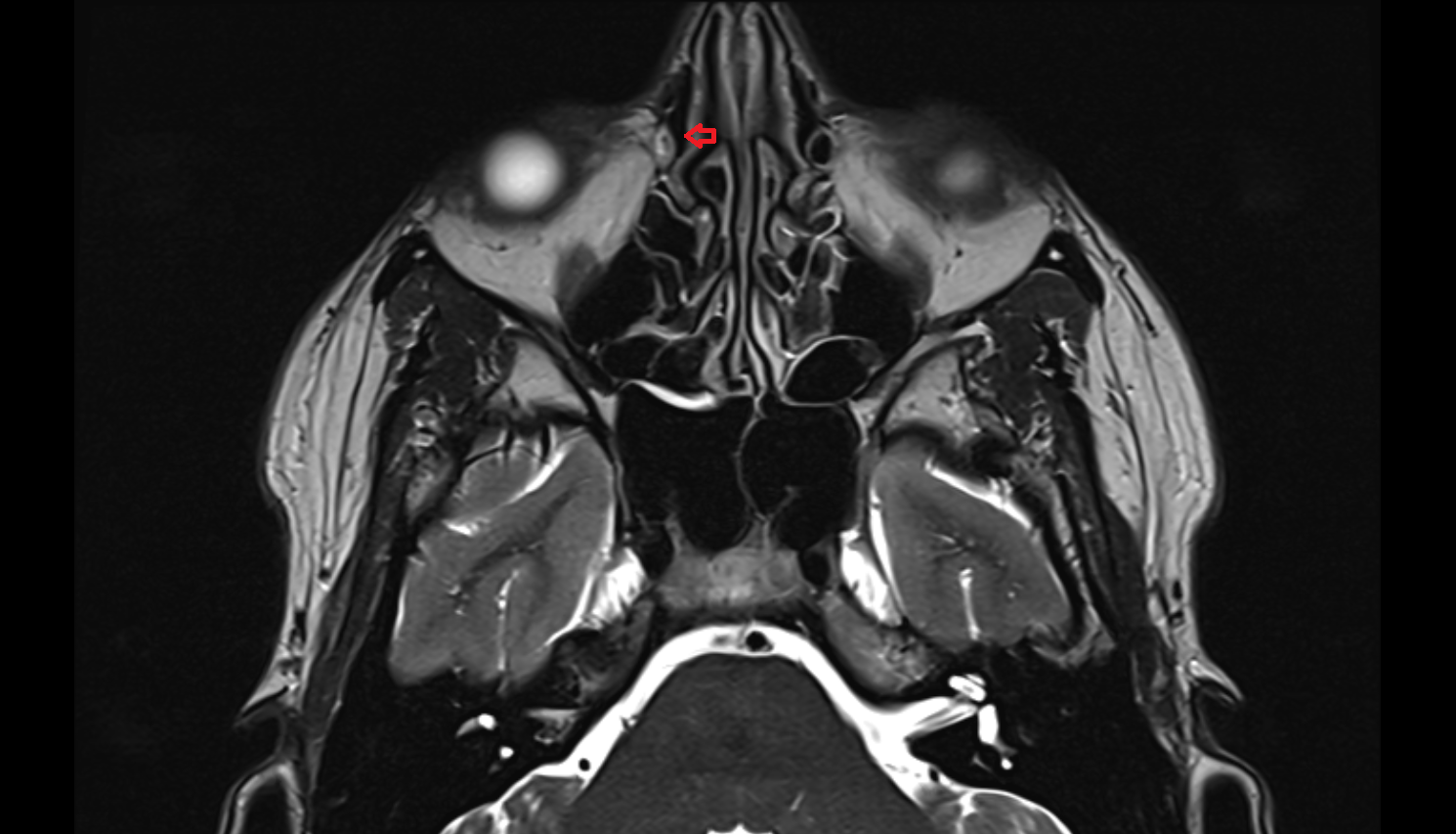 Lacrimal bone MRI axial  image-img-00000-00000