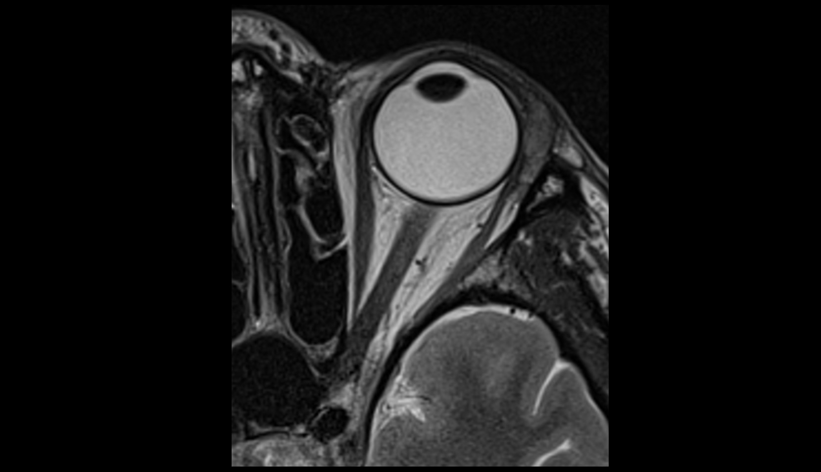 Lacrimal gland axial mri  image