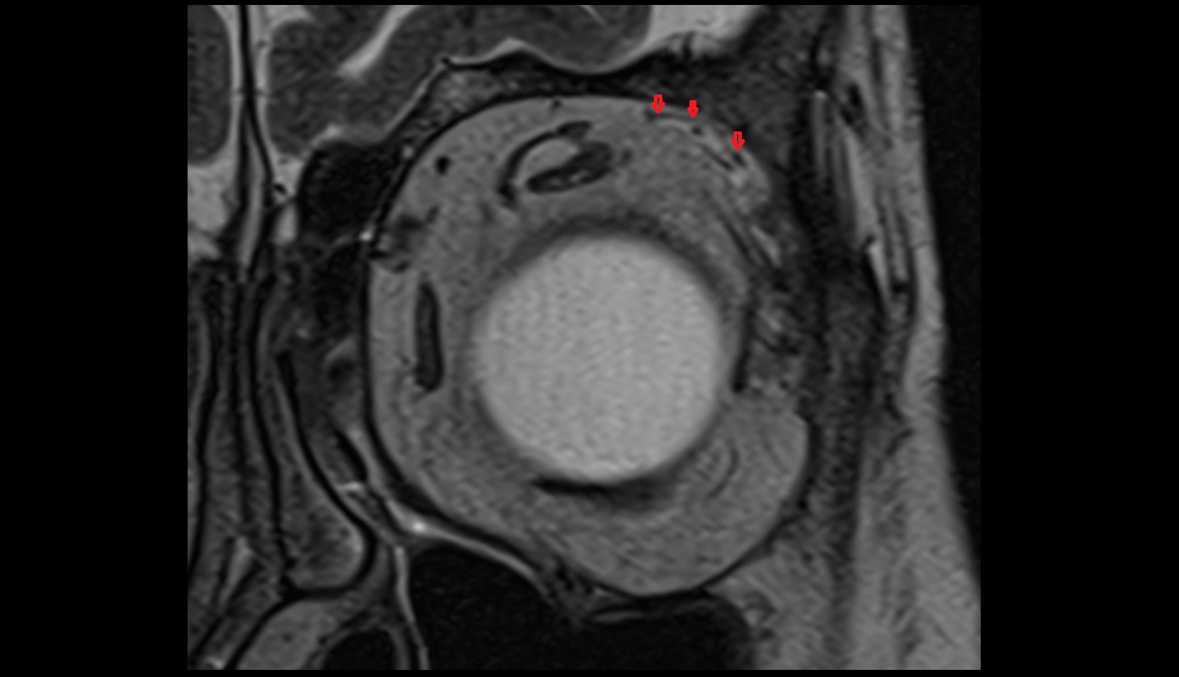 Lacrimal vein mri image