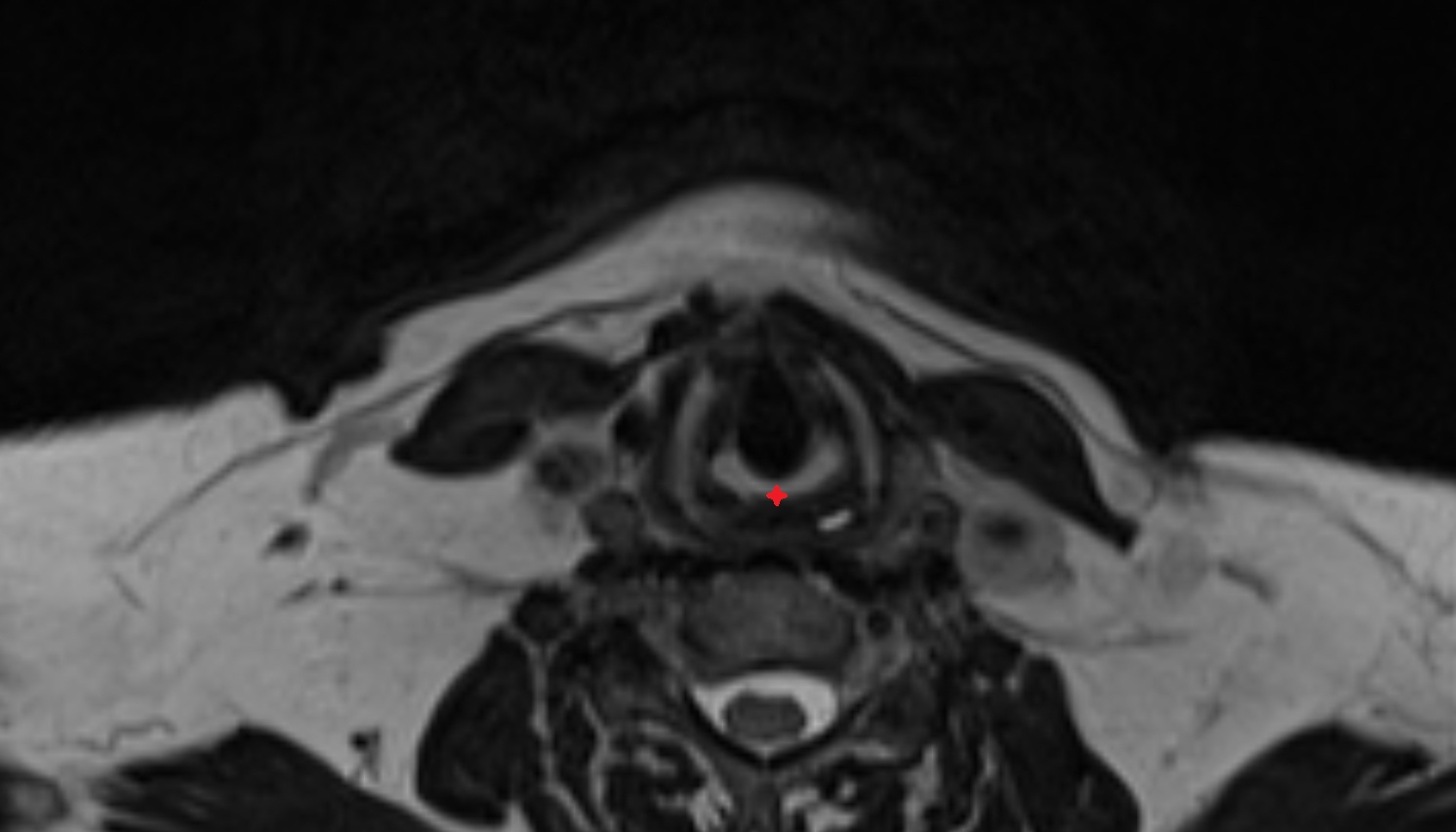 Lamina of cricoid cartilage  mri axial  image -img-00000-00000