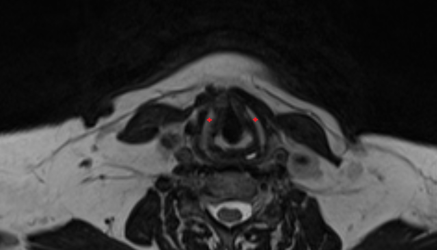 Lamina of thyroid cartilage   mri axial  image -img-00000-00000