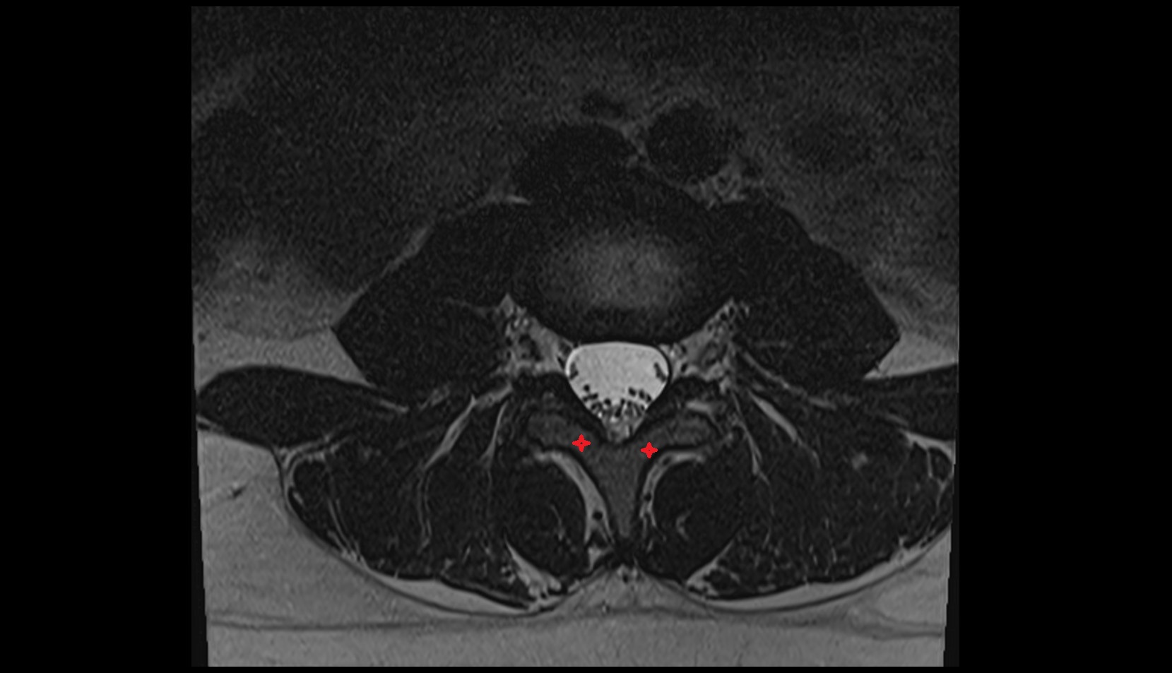 Lamina of  vertebra mri  axial  image