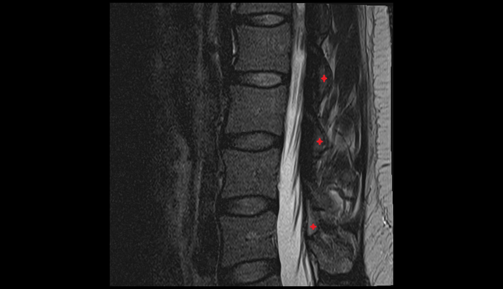 Lamina of  vertebra mri sagittal image