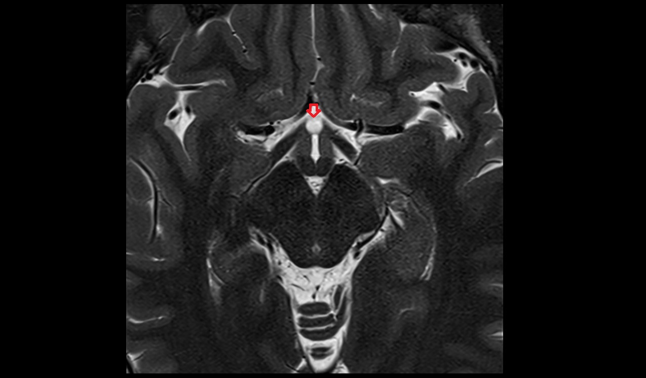 Lamina terminalis mri 3t axial image