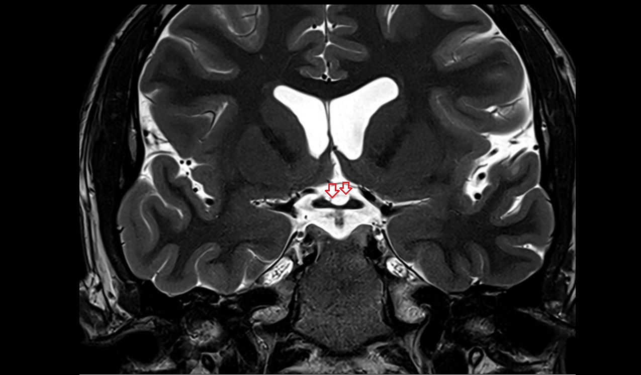 Lamina terminalis mri 3t coronal image