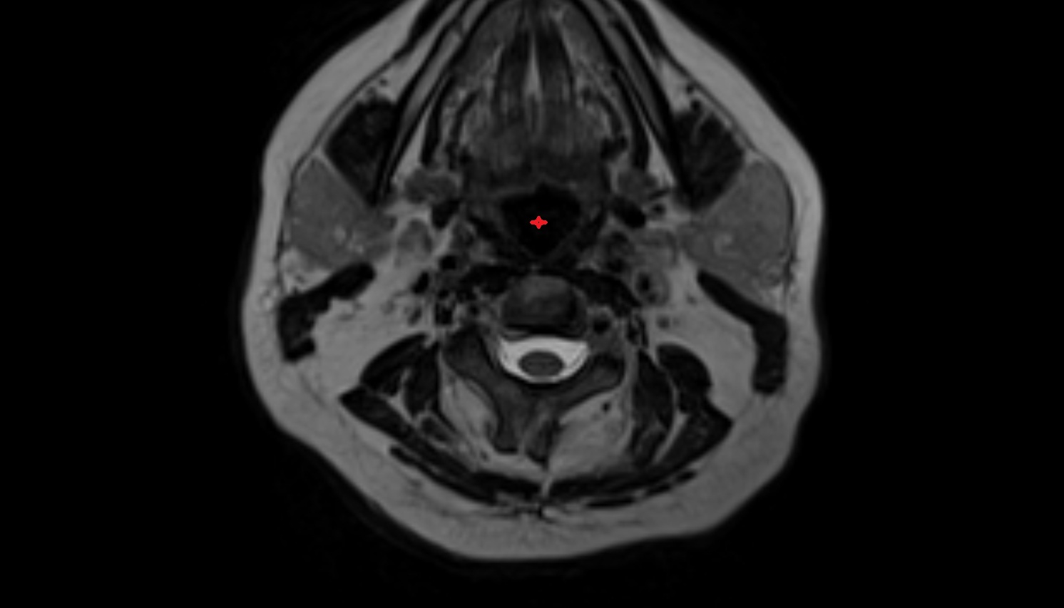 Laryngeal inlet-img-00000-00000