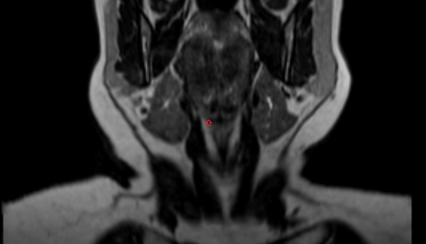 Laryngeal ventricle-img-00000-00000