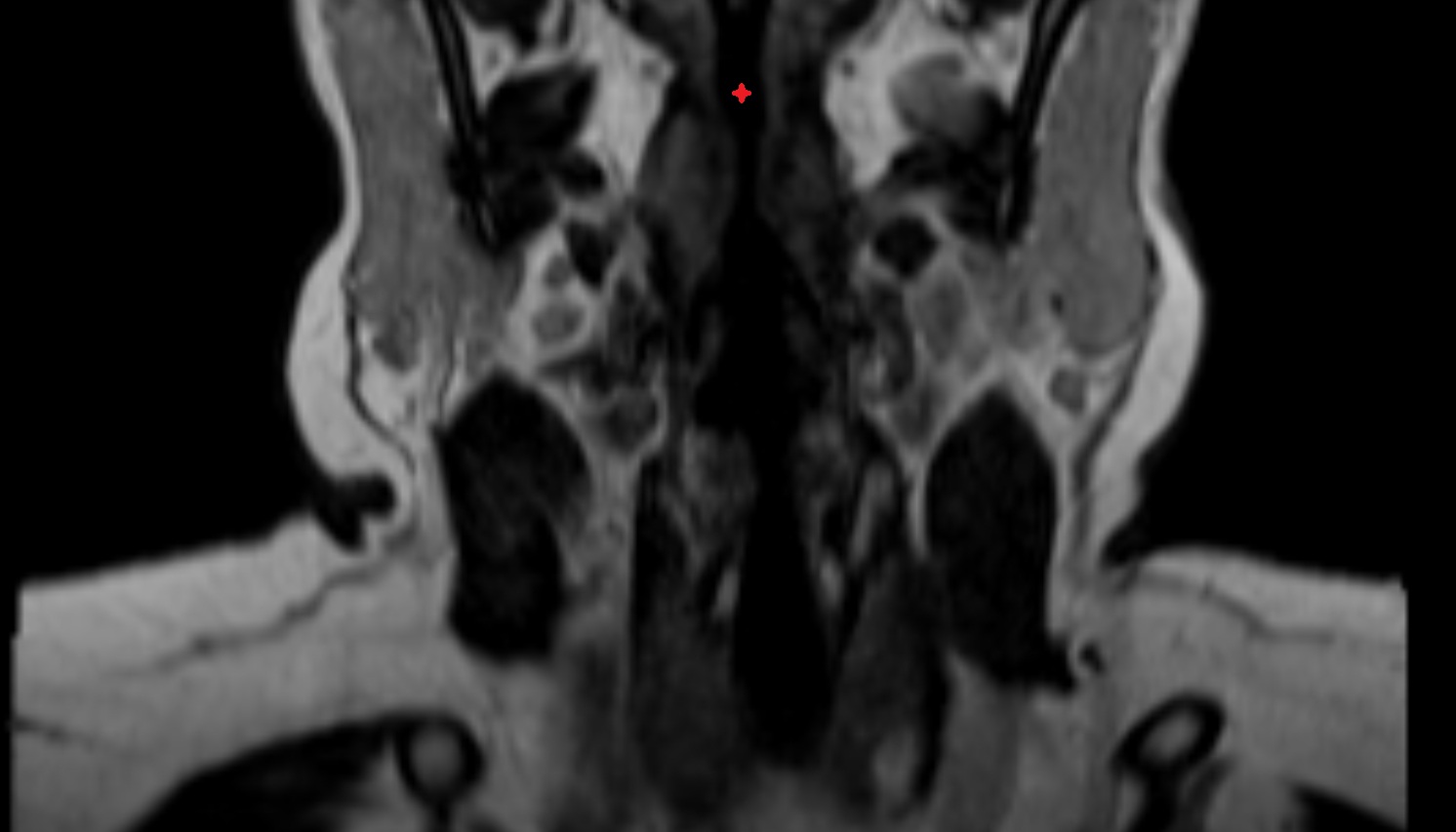Laryngeal vestibule mri image-img-00000-00000