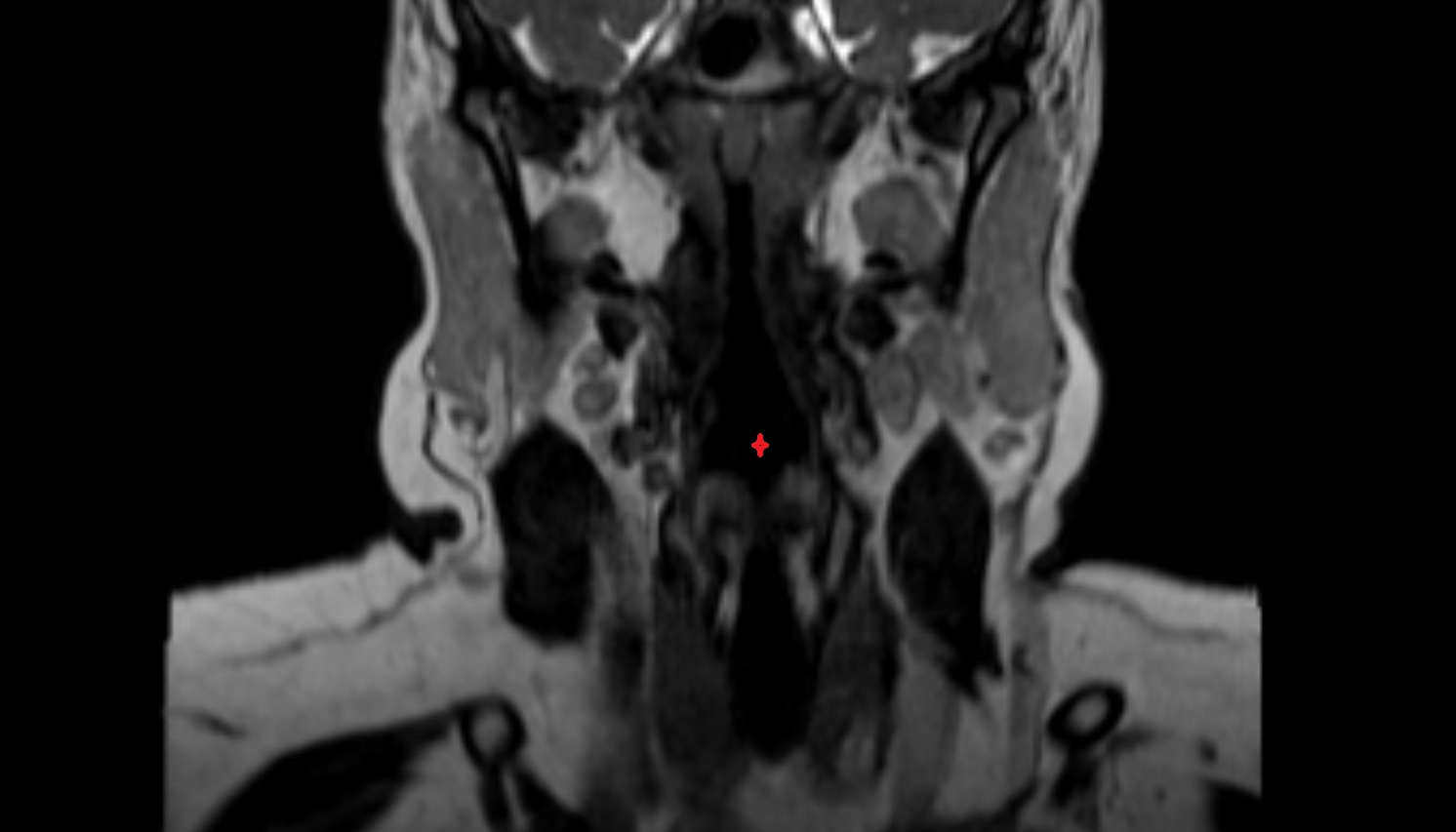 Laryngopharynx mri-img-00000-00000