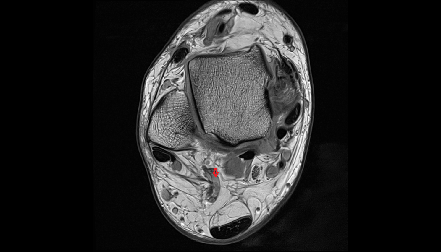Lateral Calcaneal Vein  AXIAL  cross sectional anatomy 3T MRI AI enhanced radiology image-img-00000-00000