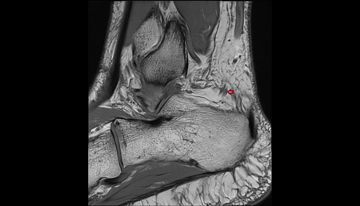 Lateral Calcaneal Vein  SAG  cross sectional anatomy 3T MRI AI enhanced radiology image-img-00000-00000