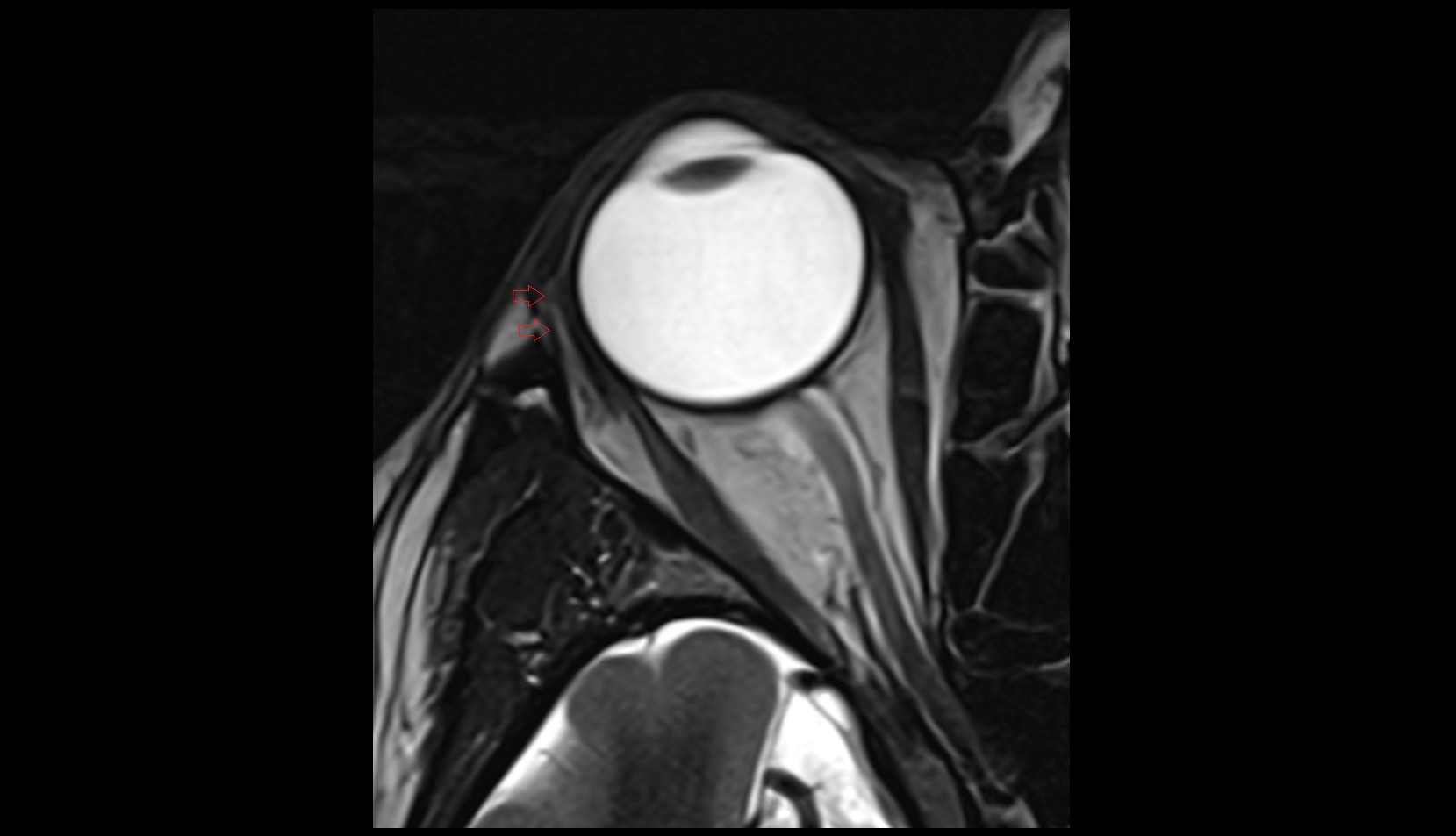 Lateral Canthal Ligament MRI IMAGE