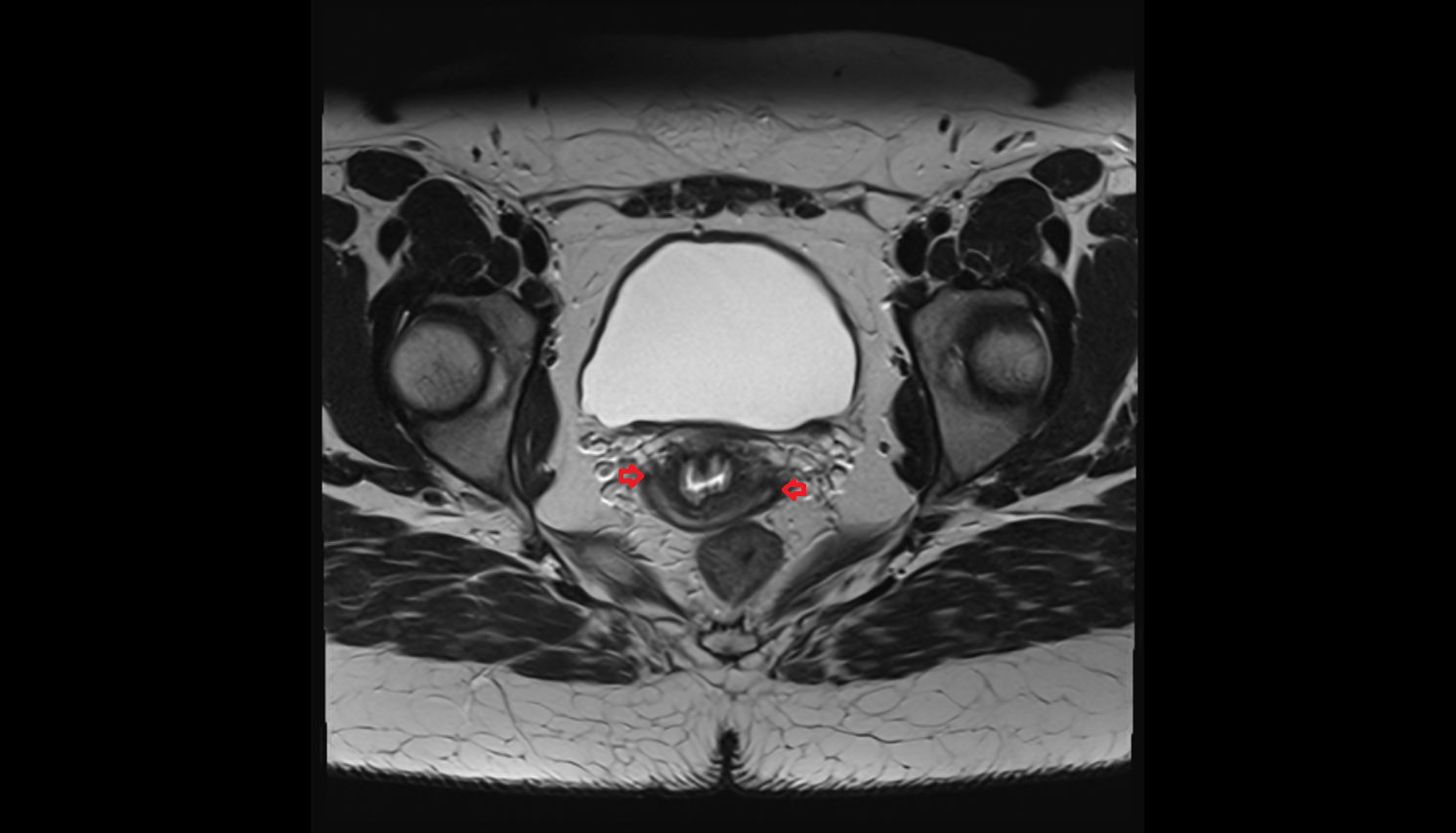 Lateral Fornix  MRI axial image-img-00000-00000