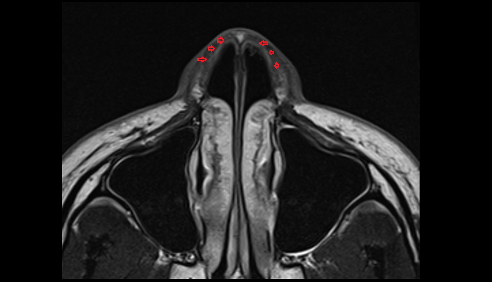 Lateral Nasal Cartilage MRI