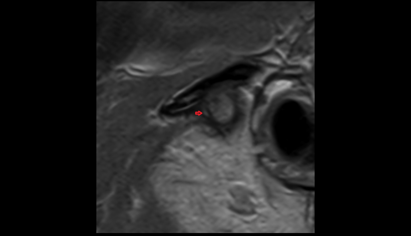 Lateral Temporomandibular Ligament MRI