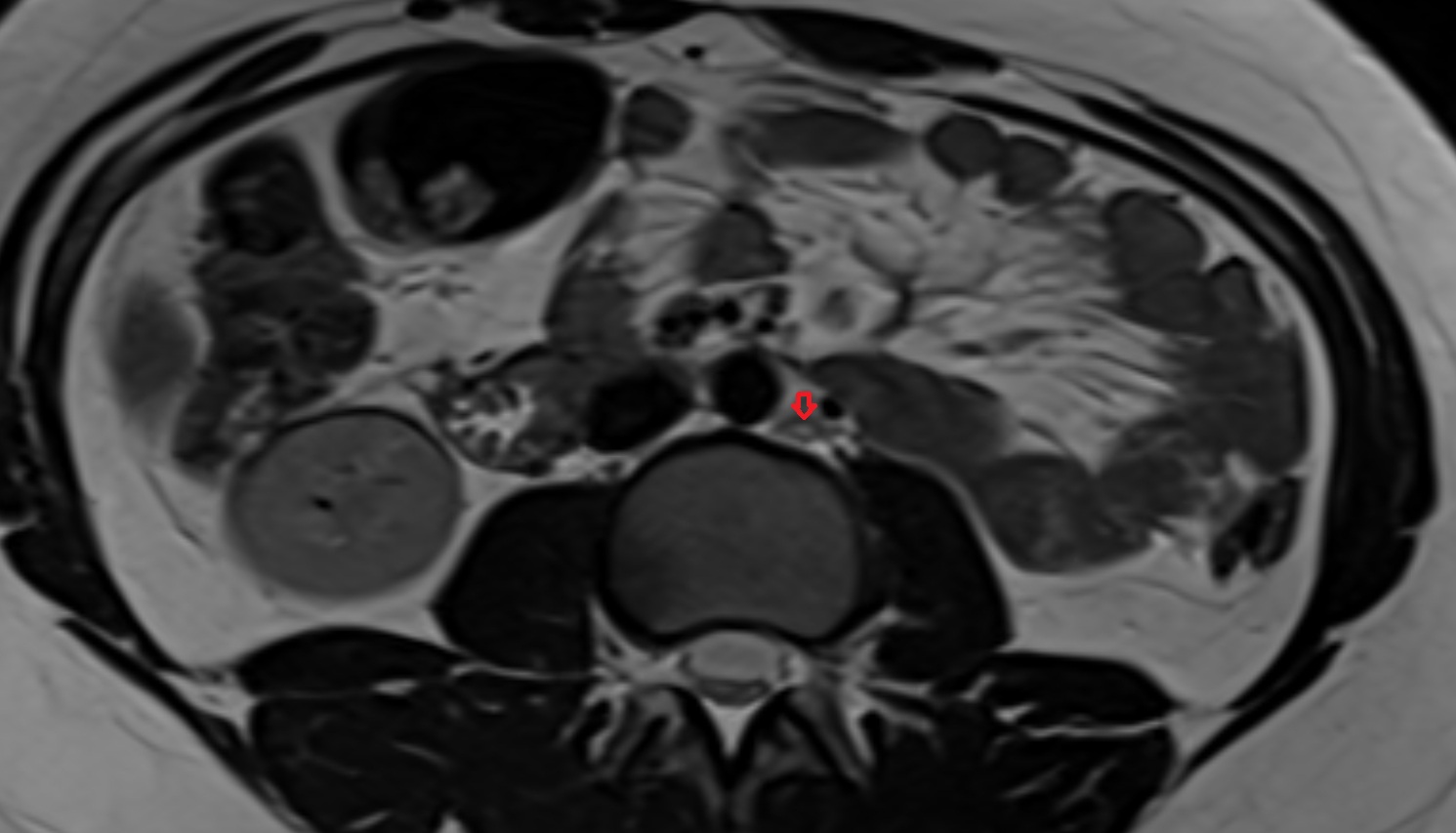 Lateral aortic lymph nodes  MRI axial  image anatomy  image -img-00000-00000