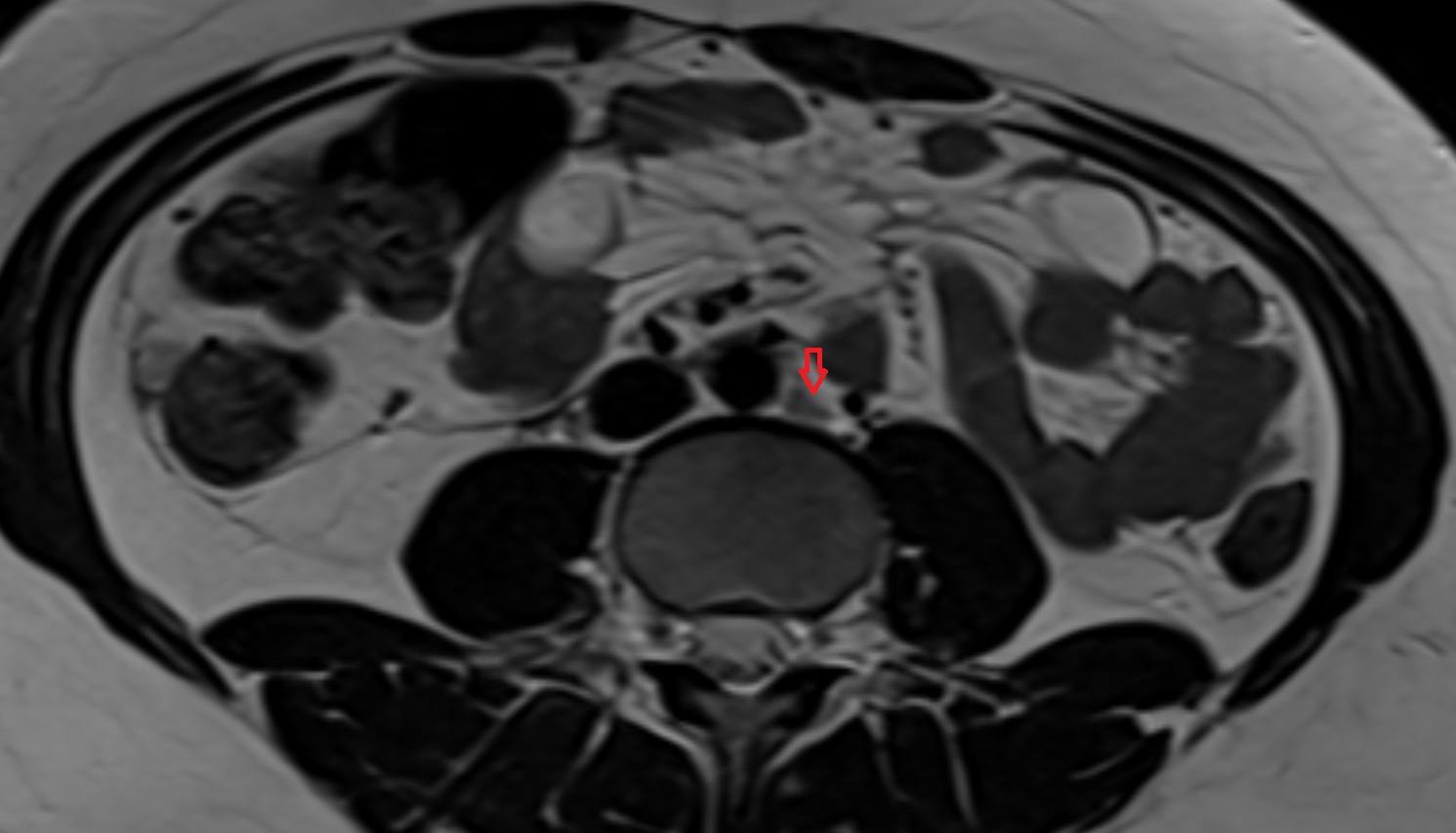Lateral aortic lymph nodes  MRI axial  image anatomy  image -img-00000-00000_00001