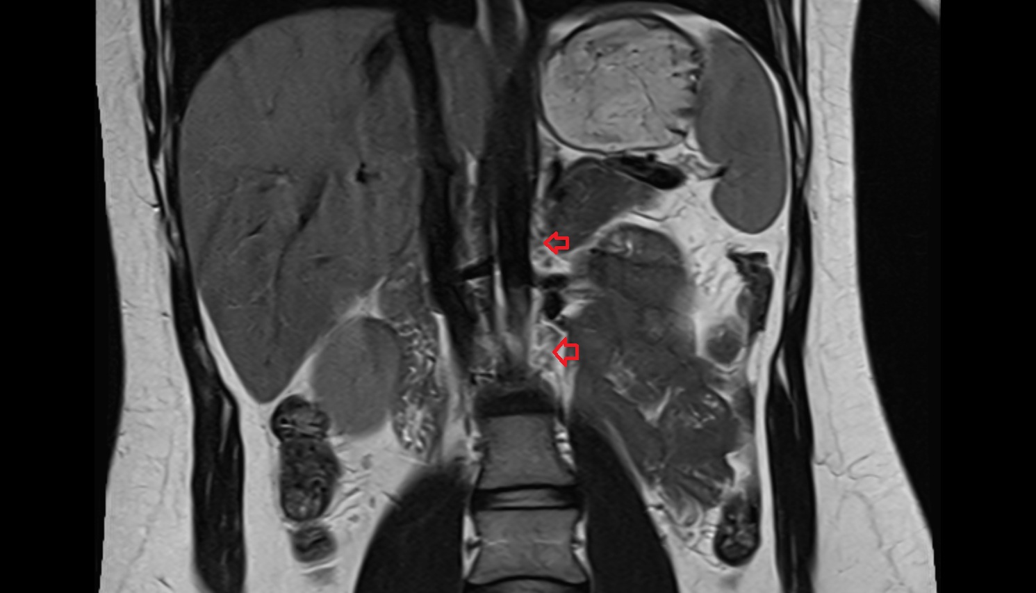 Lateral aortic lymph nodes  MRI coronal  image anatomy  image -img-00000-00000_00002