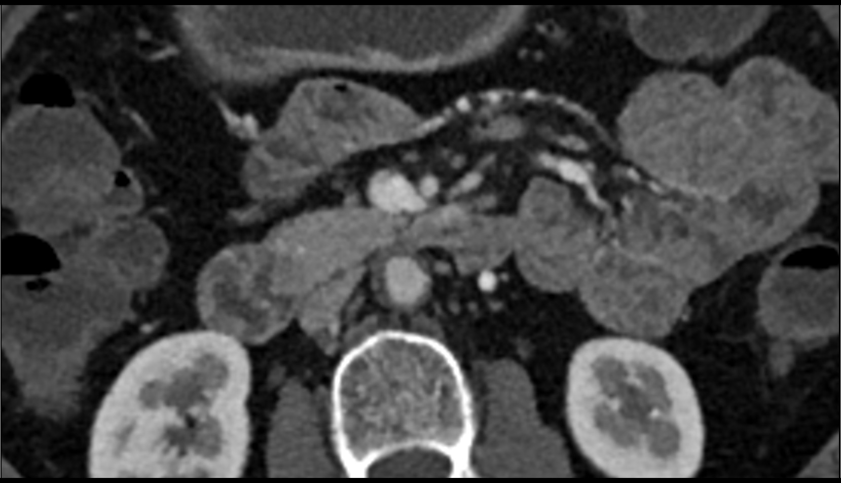 Lateral aortic lymph nodes axial ct image