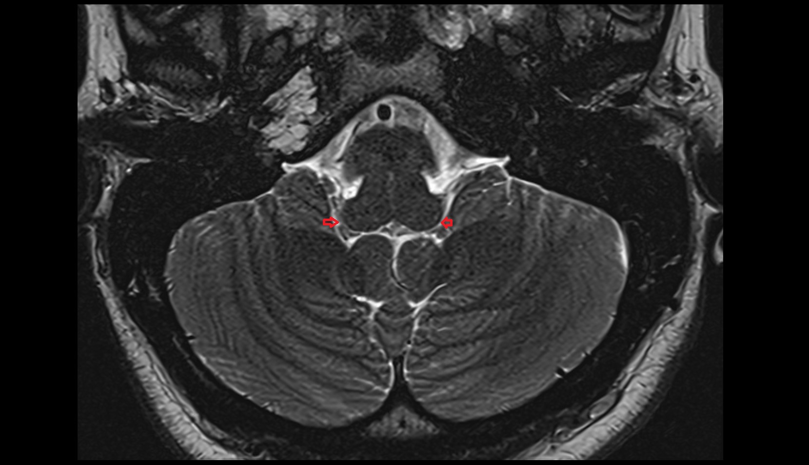 Lateral aperture of fourth ventricle (foramen of Luschka) axial iamge