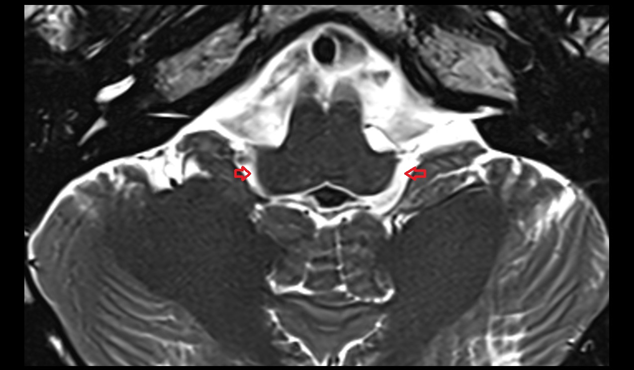 Lateral aperture of fourth ventricle mri 3t axial image