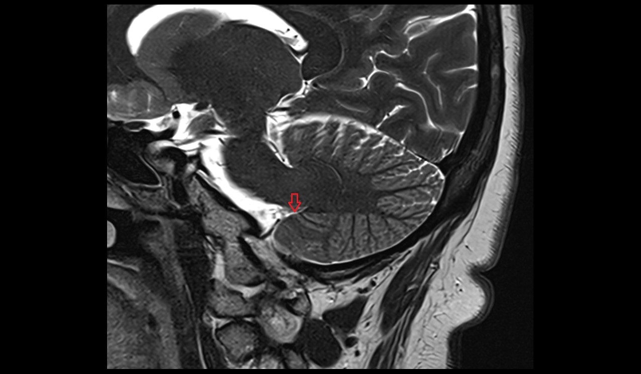 Lateral aperture of fourth ventricle mri 3t sagittal image
