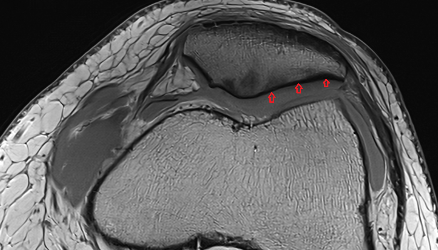 Lateral articular facet of patella axial cross sectional anatomy 3T MRI AI enhanced  radiology  anatomy image-img-00000-00000