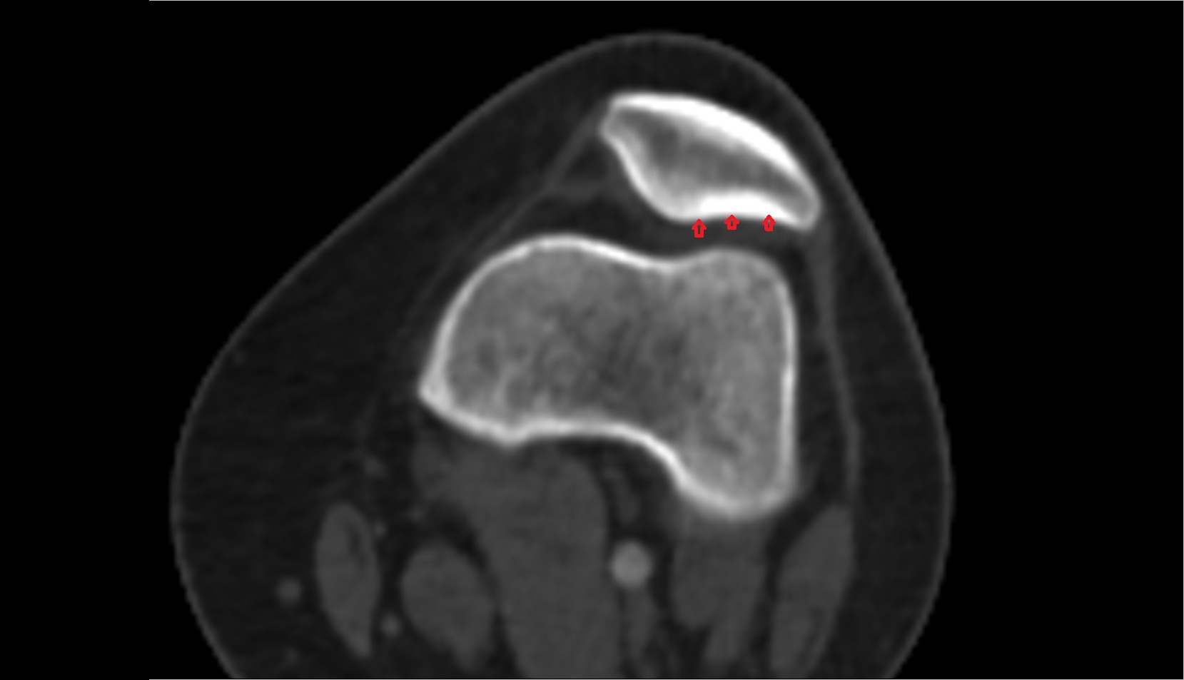 Lateral articular facet of patella ct axial
