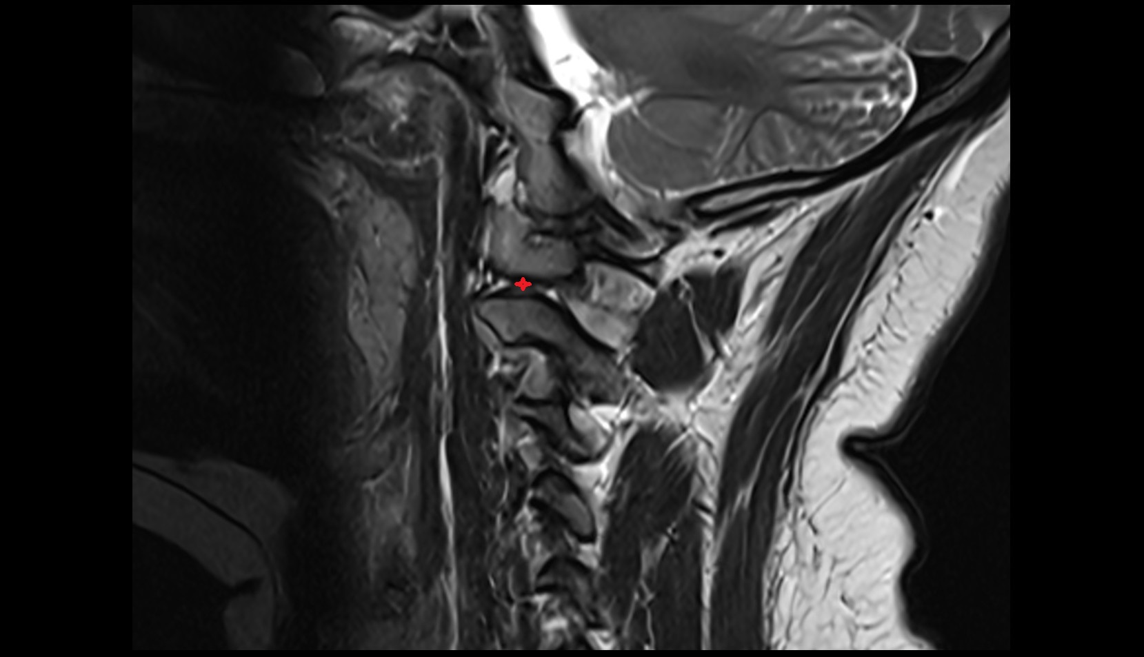 Lateral atlantoaxial joint MRI sagittal image