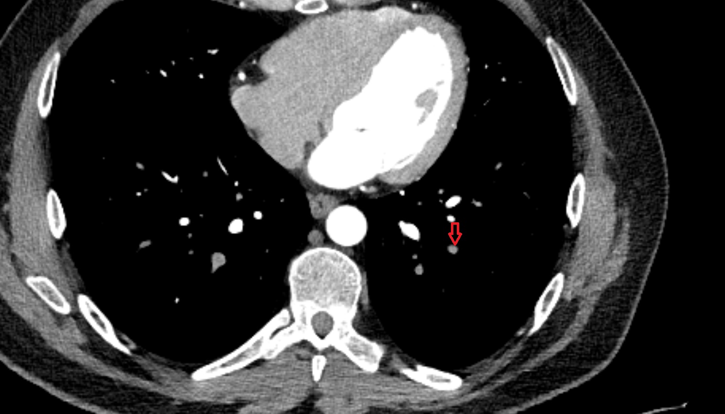 Lateral basal segmental artery of left lung  anatomy CT axial  image -img-00000-00000