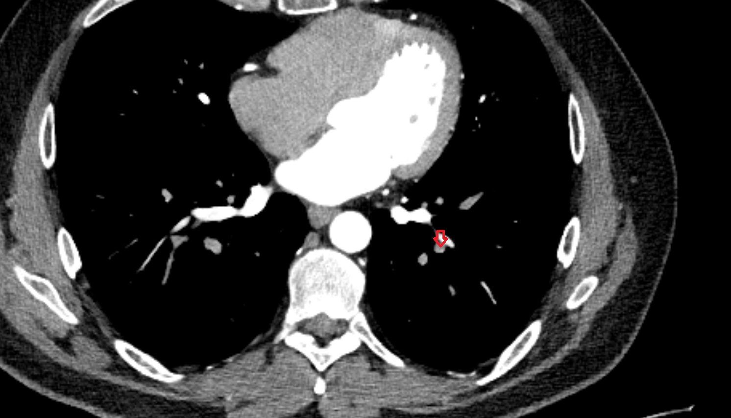 Lateral basal segmental artery of left lung  anatomy CT axial  image -img-00000-00000_00001