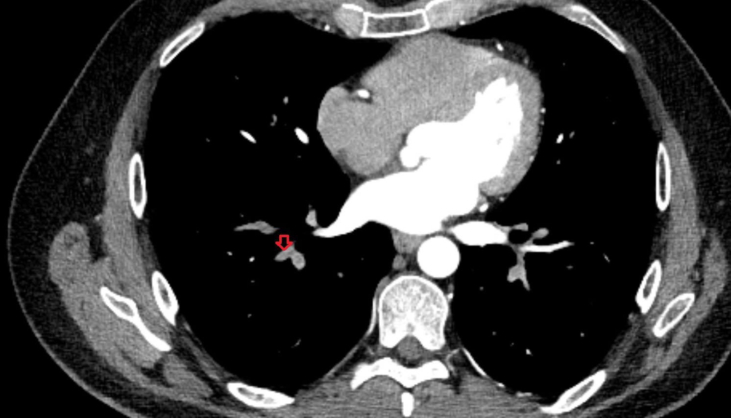 Lateral basal segmental artery of right lung  anatomy CT axial  image -img-00000-00000
