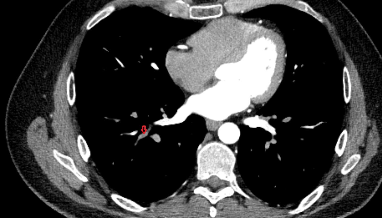 Lateral basal segmental artery of right lung  anatomy CT axial  image -img-00000-00000_00001