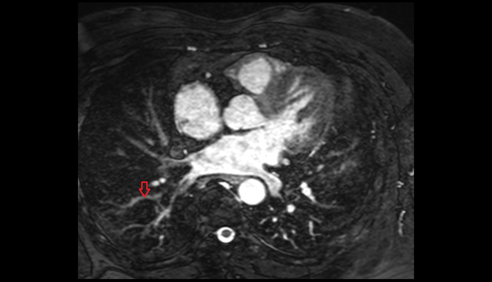 Lateral basal segmental artery of right lung mri image