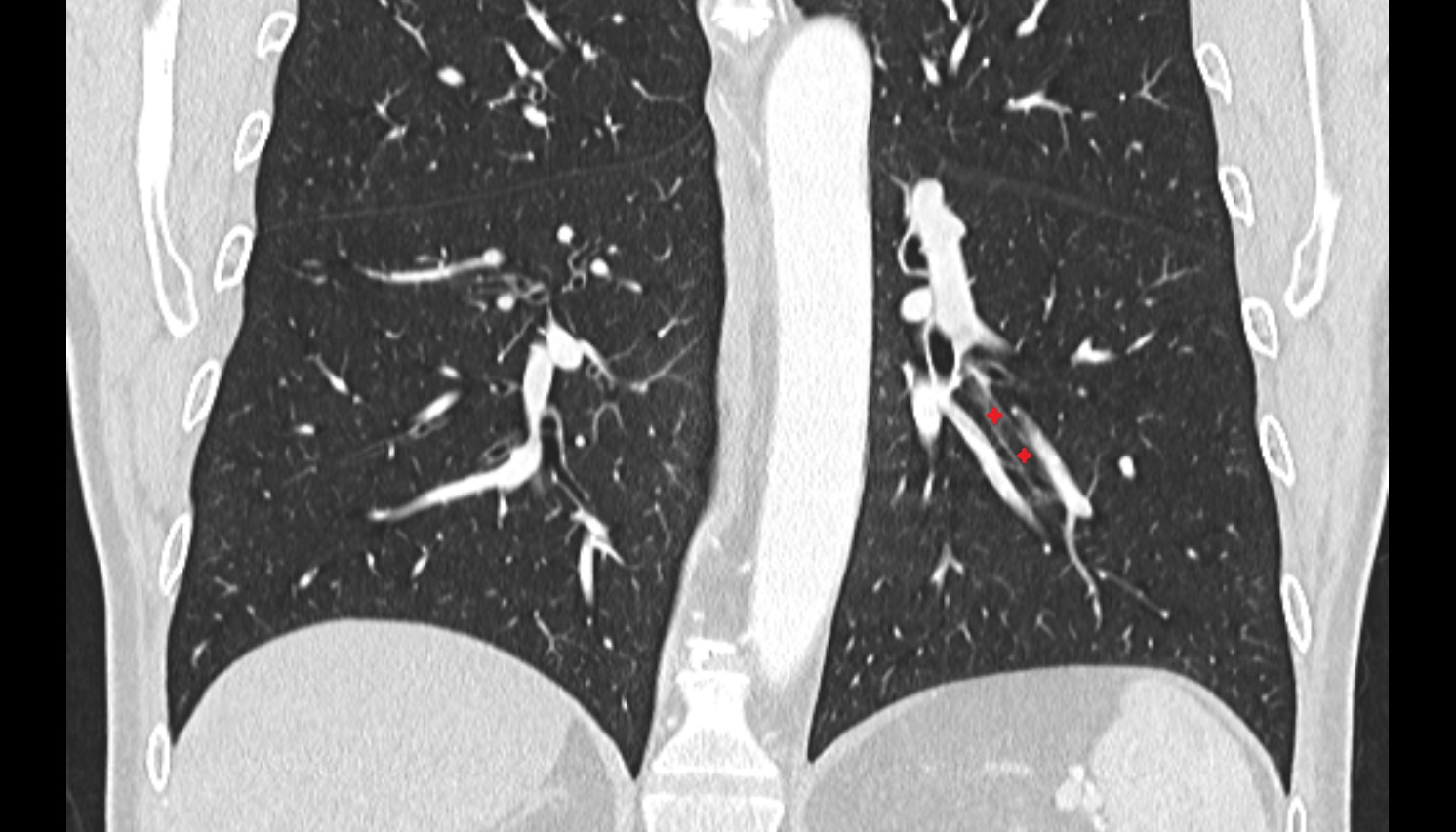 Lateral basal segmental bronchus of left lung (B9)  anatomy  CT coronal  image -img-00000-00000