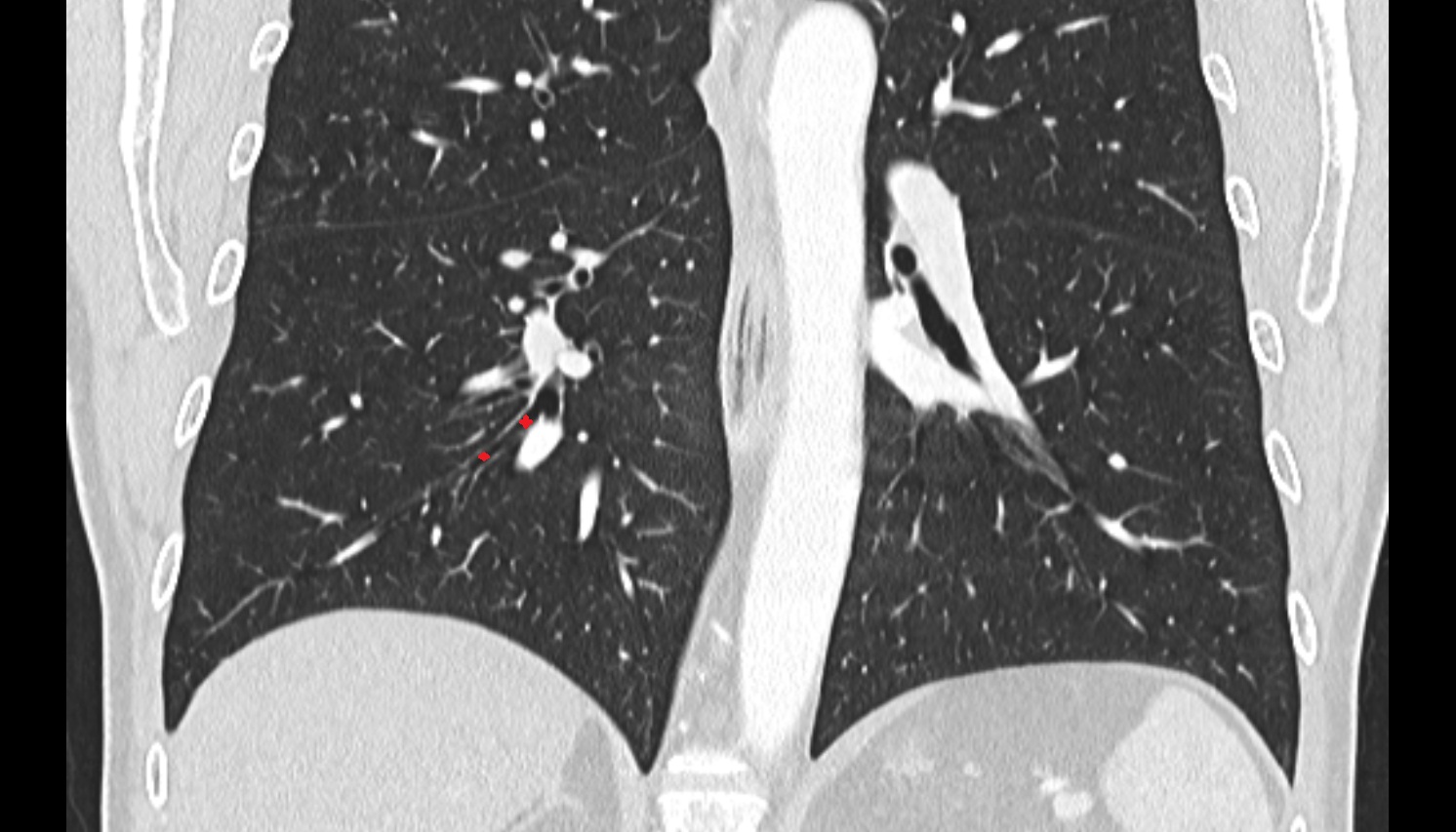 Lateral basal segmental bronchus of right lung (B9)  anatomy  CT coronal  image -img-00000-00000