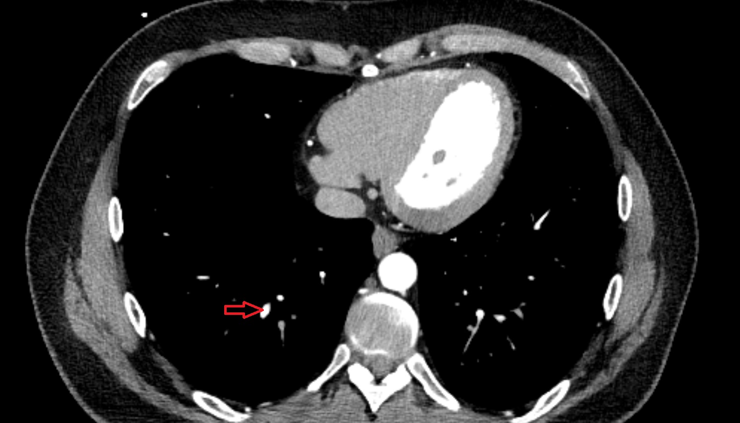 Lateral basal vein of right lung anatomy CT axial  image -img-00000-00000