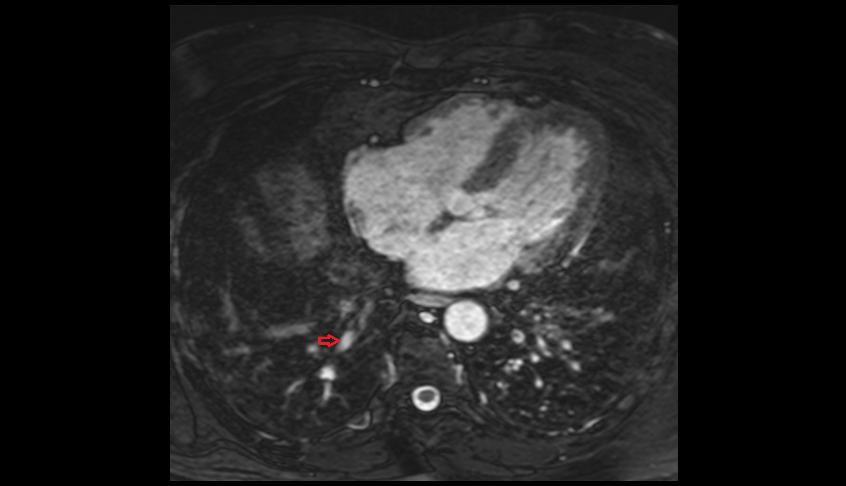 Lateral basal vein of right lung mri image