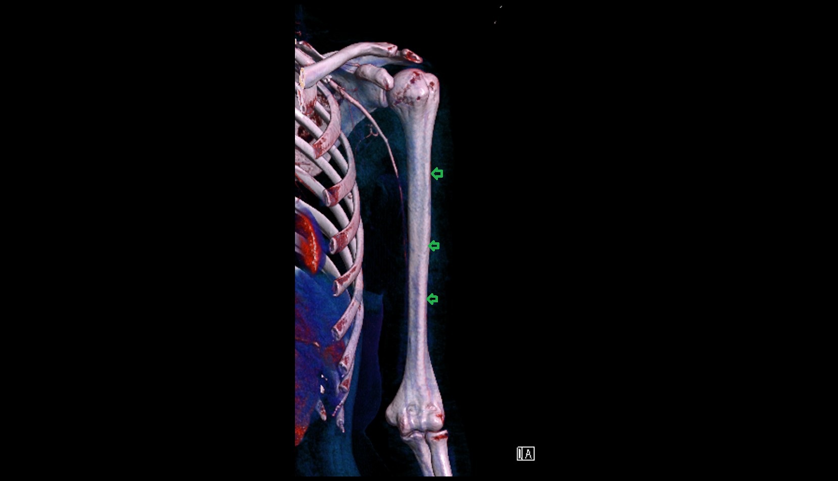 Lateral border of humerus